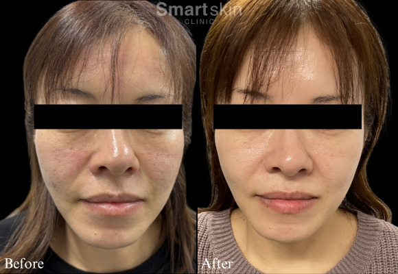 Jubeluk skin texture improvement case (1)