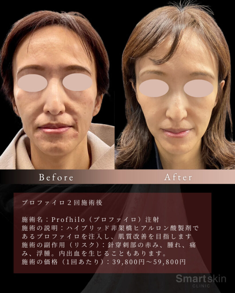 顔 たるみ 即効 性 50 代