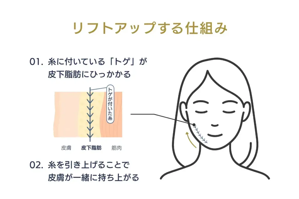 糸リフトの仕組みを示す3D皮膚断面図。コグ糸で皮膚が引き上がり、リフトアップするプロセスを可視化