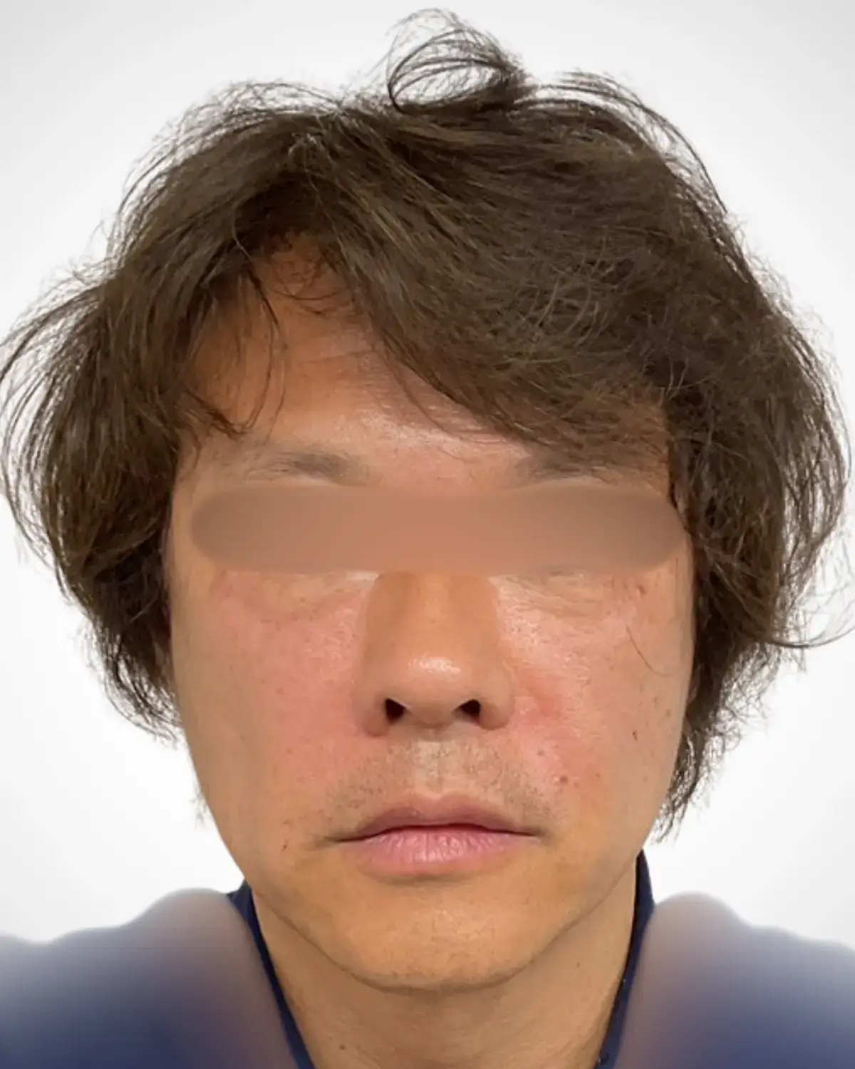 施術後