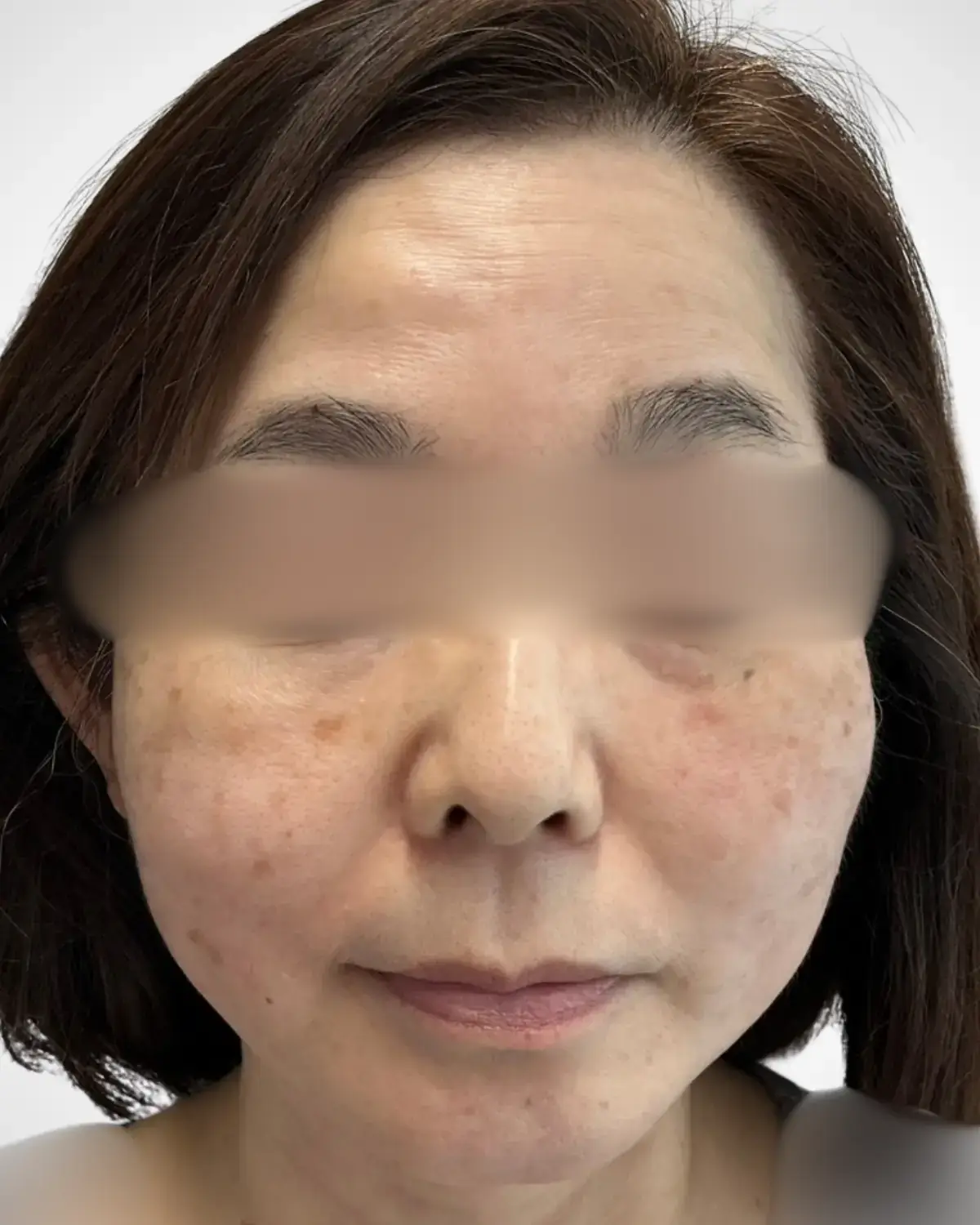 施術後