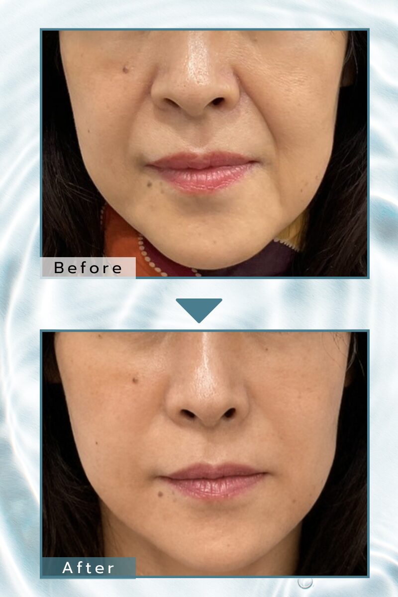50代女性ほうれい線症例Before/After