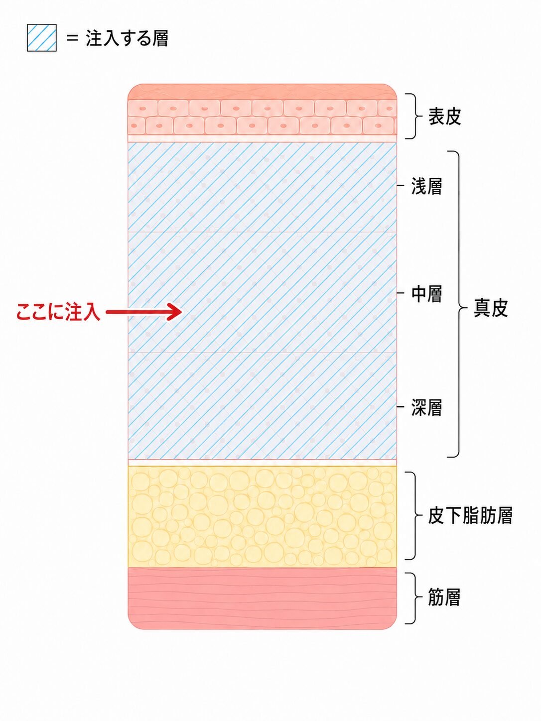 皮膚の層構造と真皮全層(浅層〜深層)への注入範囲を示した断面図
