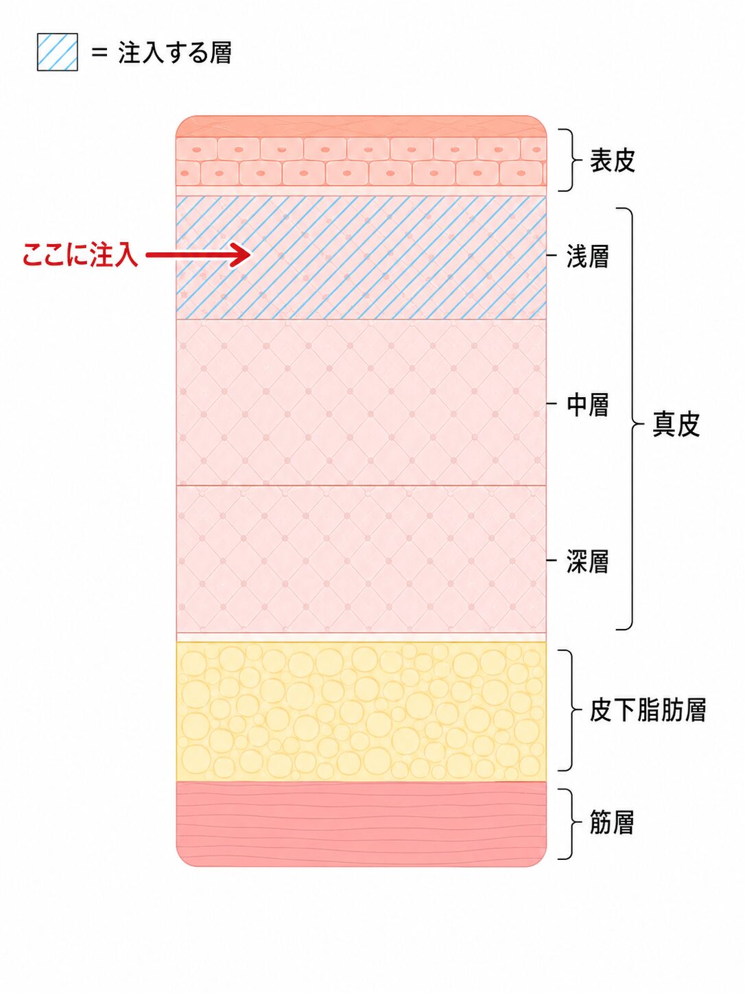 皮膚の層構造と真皮浅層への注入位置を示した断面図