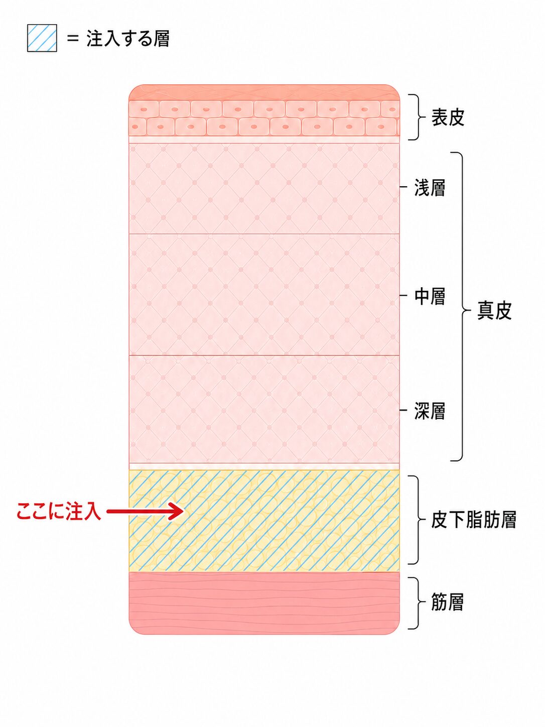 피부의 층 구조와 피하 지방층에 대한 주입 위치를 나타낸 단면도