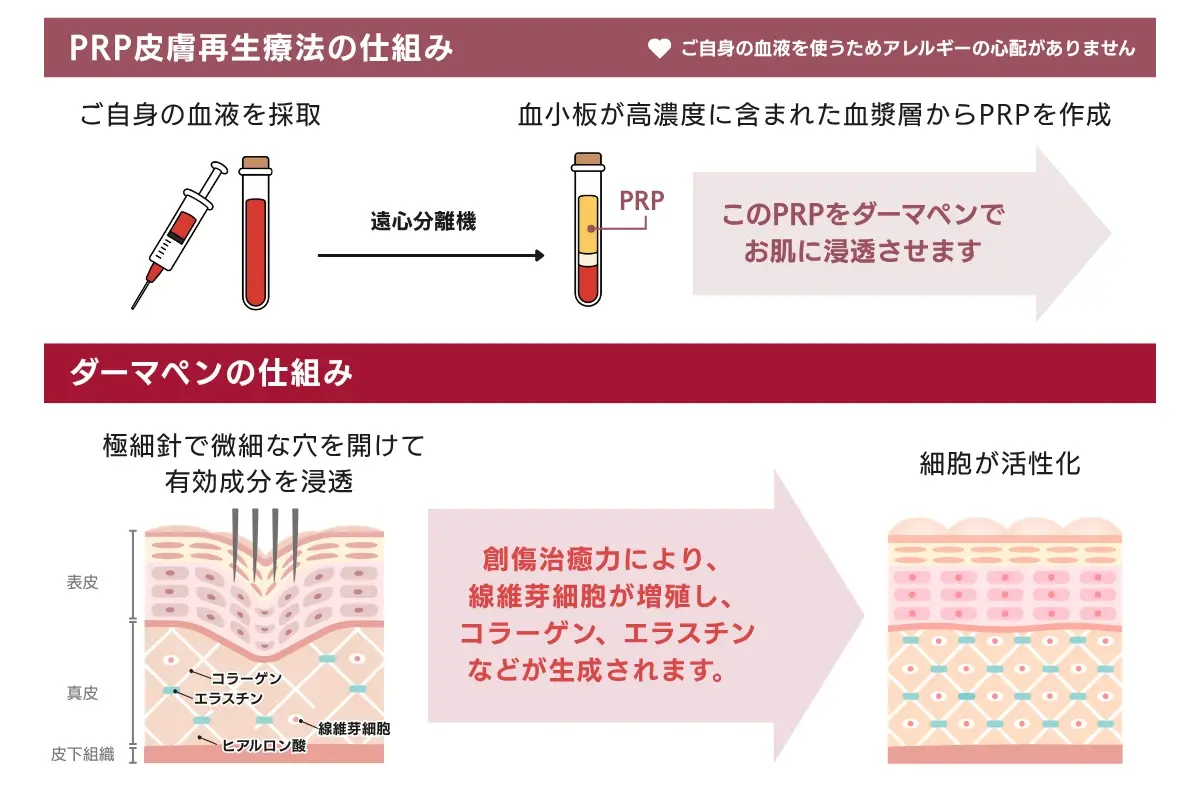 ヴァンパイアフェイシャルの仕組み図解