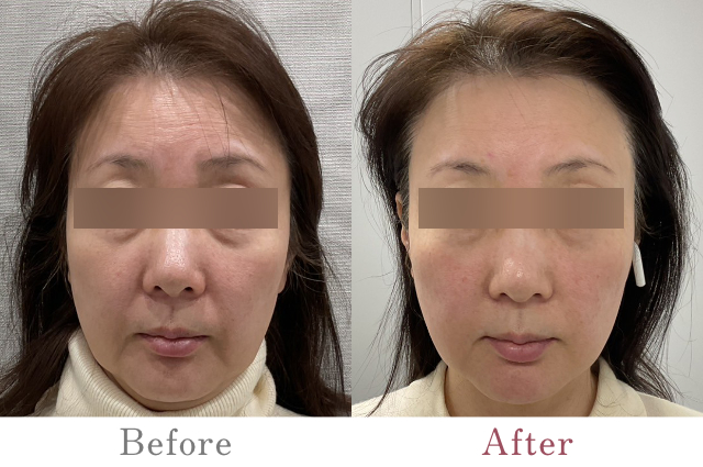 お顔全体のPRP治療（女性）：3ヶ月経過後のBefore/After比較