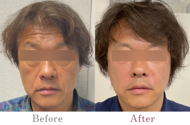 お顔全体のPRP治療（男性）：3ヶ月経過後のBefore/After比較