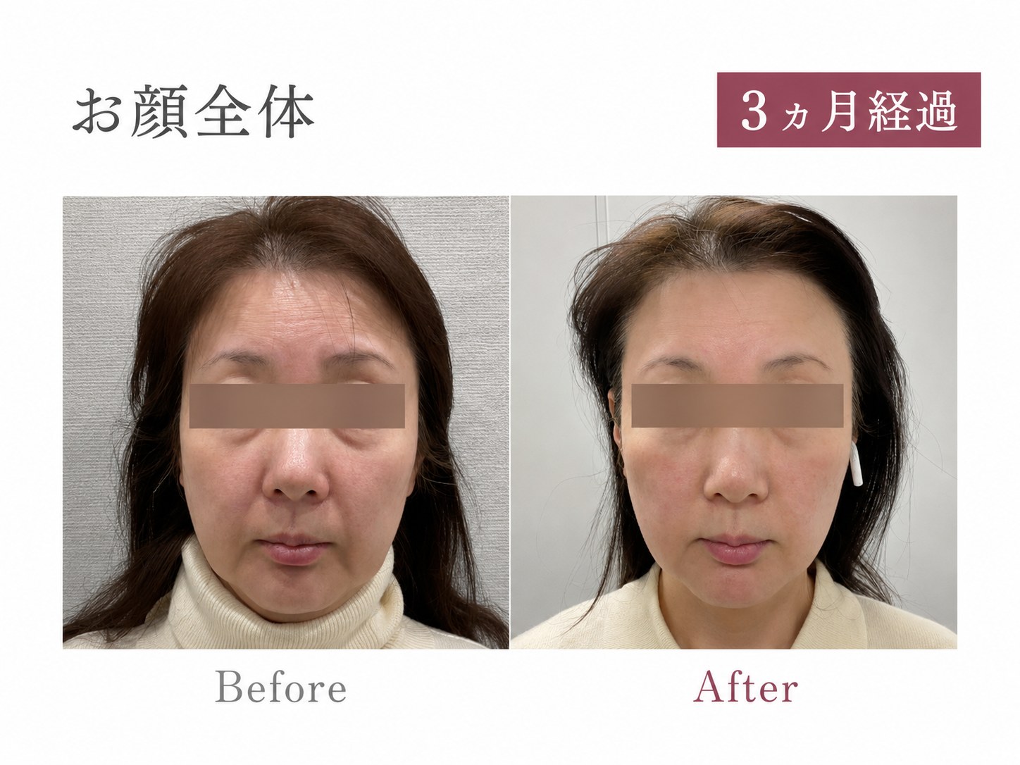 パーソナライズPRP注射症例 お顔全体 50代女性 3ヶ月経過 Before/After