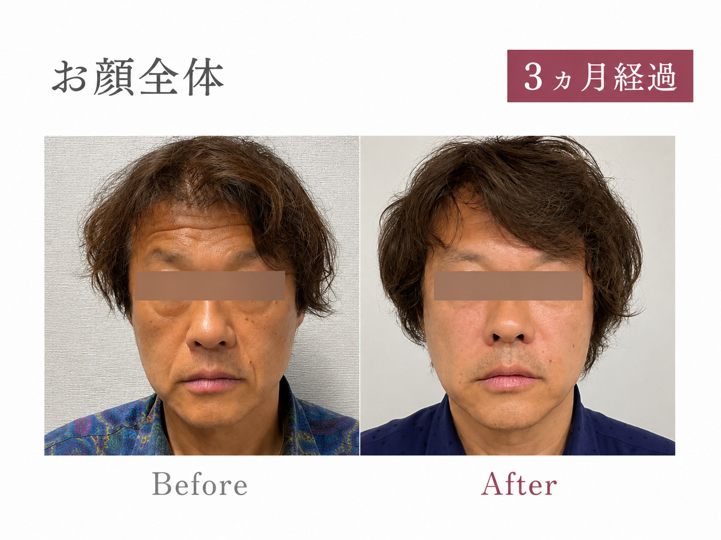 パーソナライズPRP注射症例 お顔全体 50代男性 3ヶ月経過 Before/After
