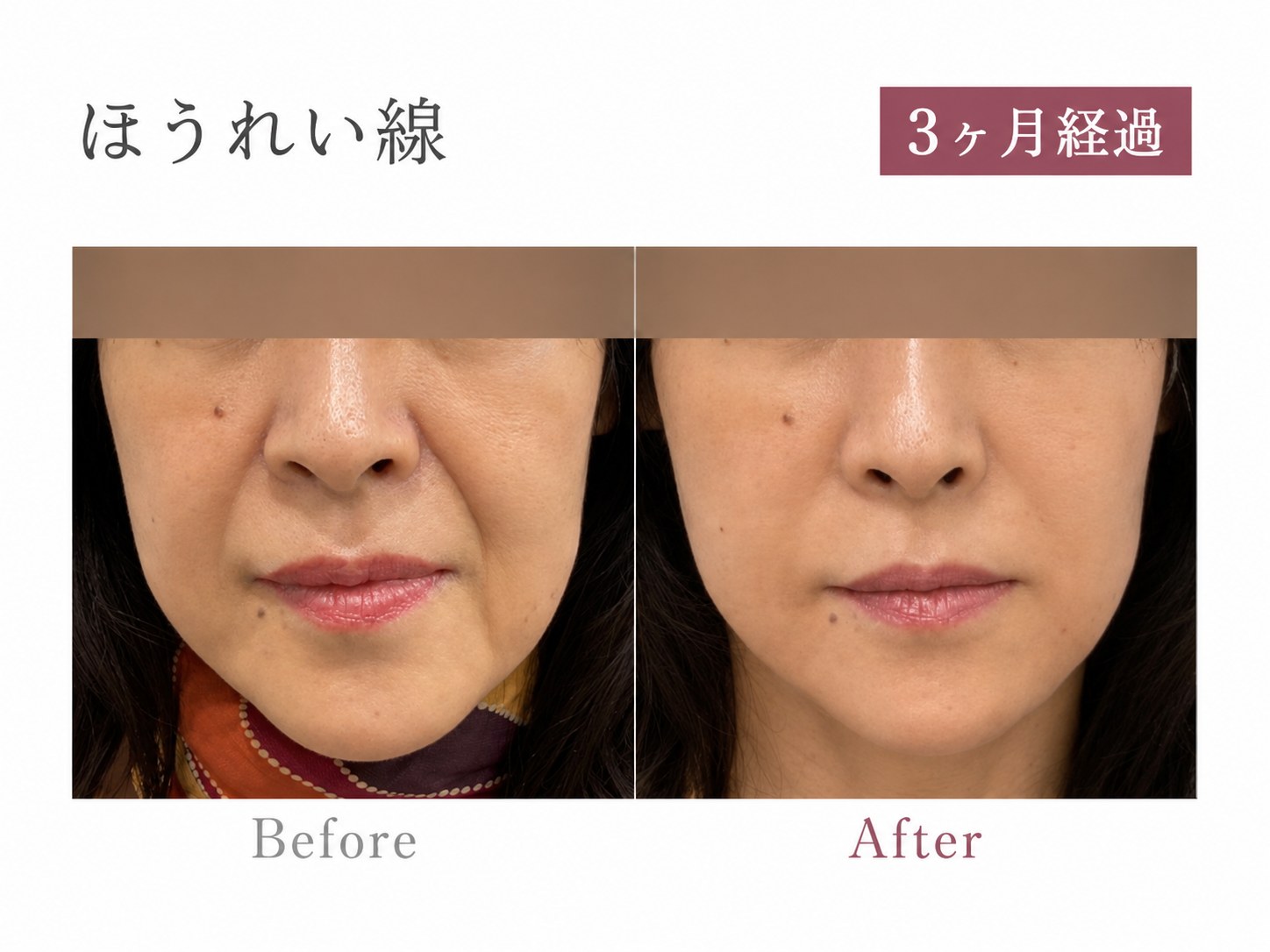 パーソナライズPRP注射症例 ほうれい線 正面 3ヶ月経過 Before/After