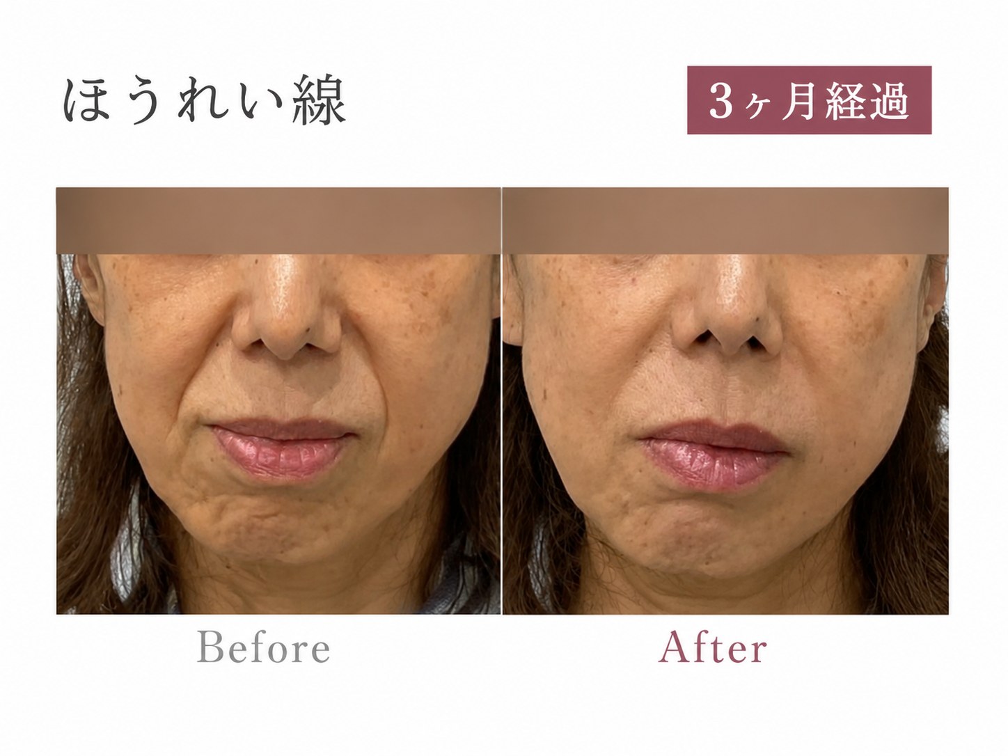 パーソナライズPRP注射症例 ほうれい線 正面 3ヶ月経過 Before/After