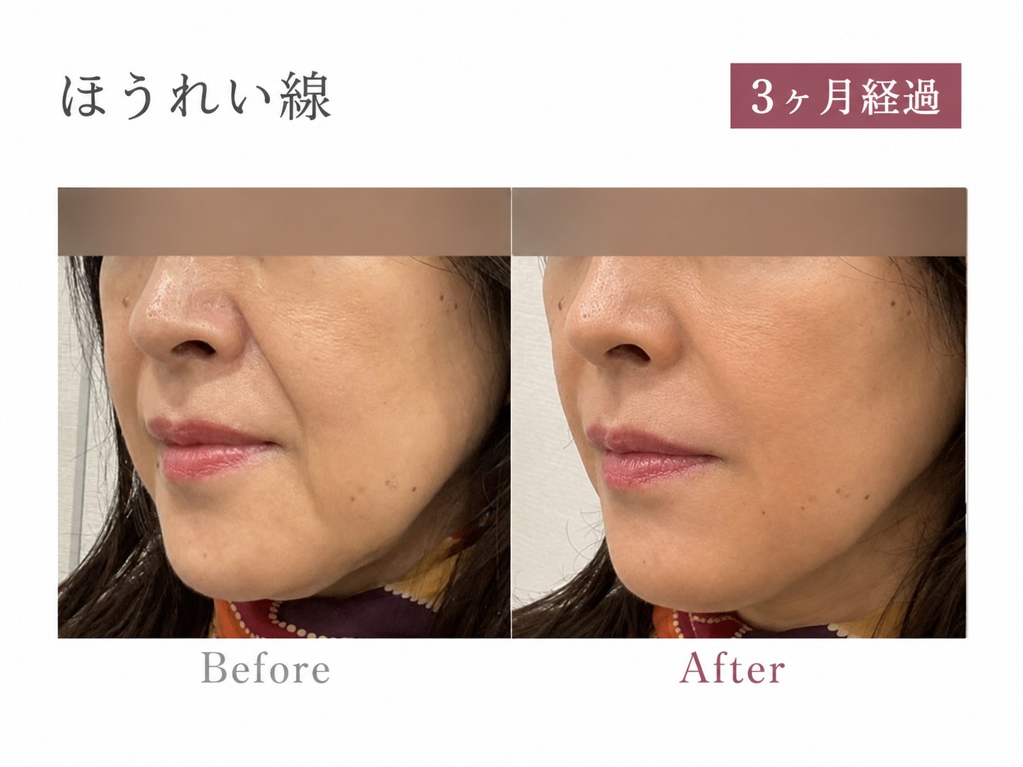 パーソナライズPRP注射症例 ほうれい線 斜め 3ヶ月経過 Before/After