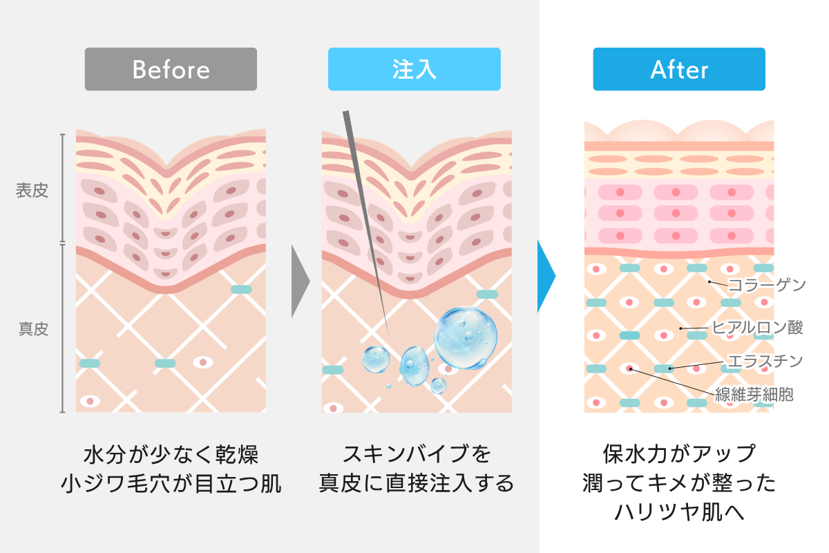 Ilustração das alterações cutâneas resultantes da injeção de SkinVibe