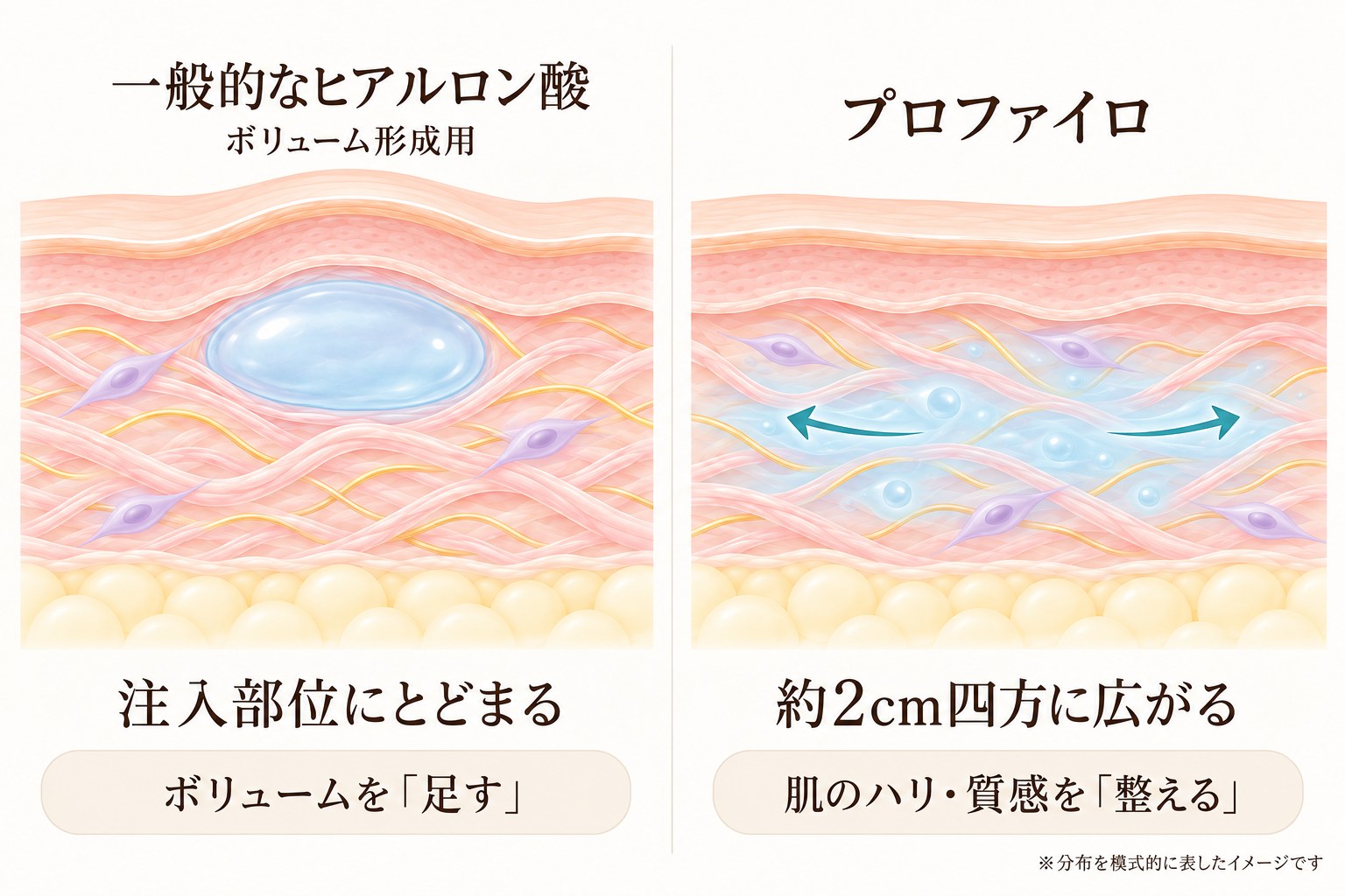 一般的なヒアルロン酸は注入部位にとどまり、プロファイロは約2cm四方に広がる比較図