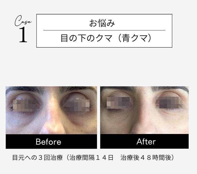 スネコス注射 症例1 目の下のクマ（青クマ）Before After