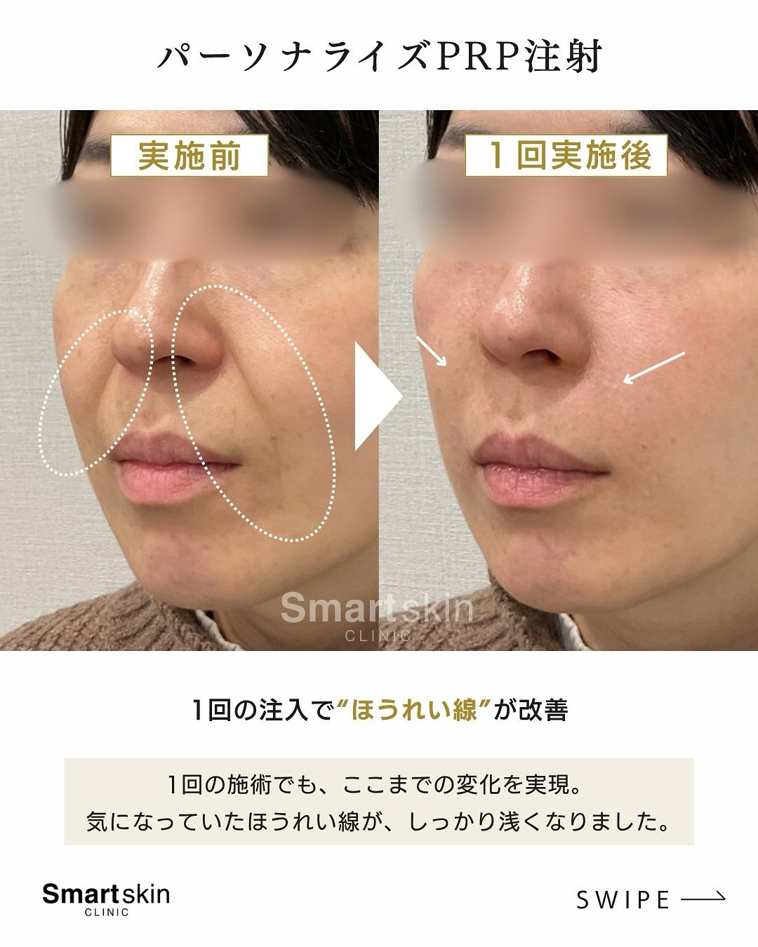 30代 ほうれい線 パーソナライズPRP注射 実施前と1回実施後