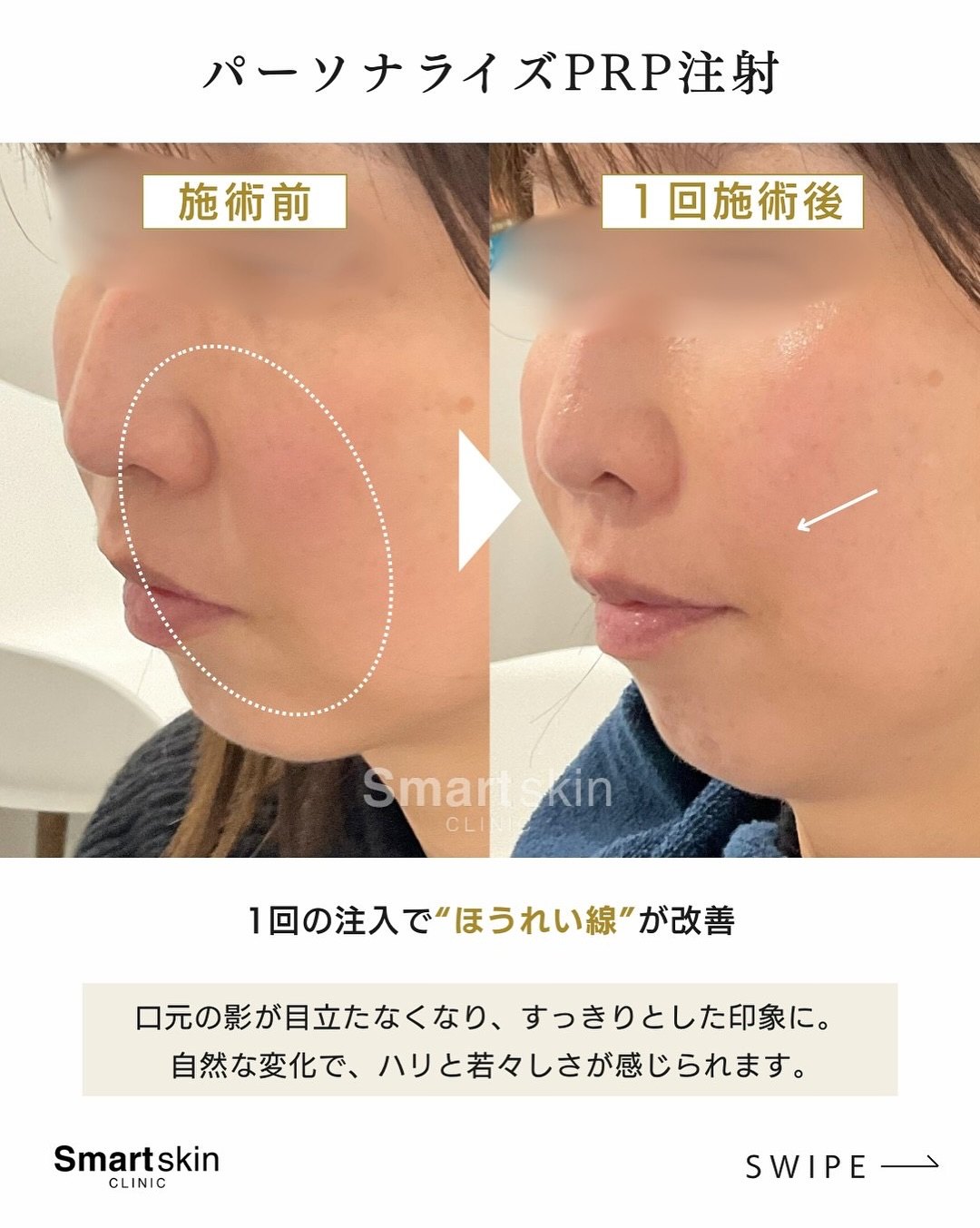 40代 ほうれい線 パーソナライズPRP注射 施術前と1回施術後