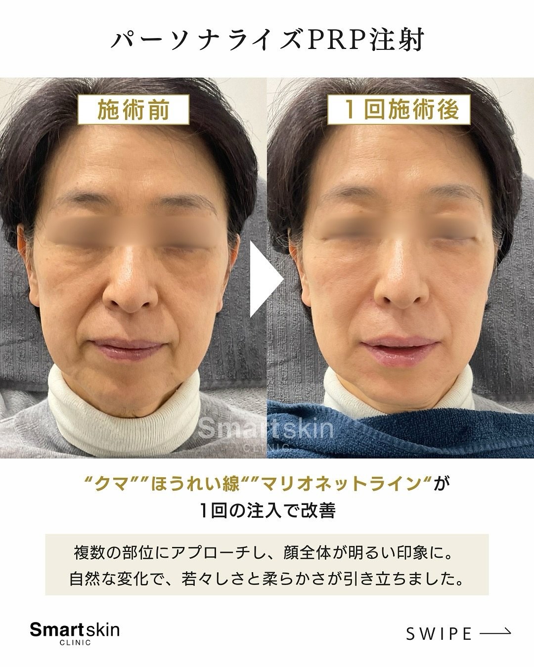 60代 ほうれい線・クマ・マリオネットライン パーソナライズPRP注射 施術前と1回施術後